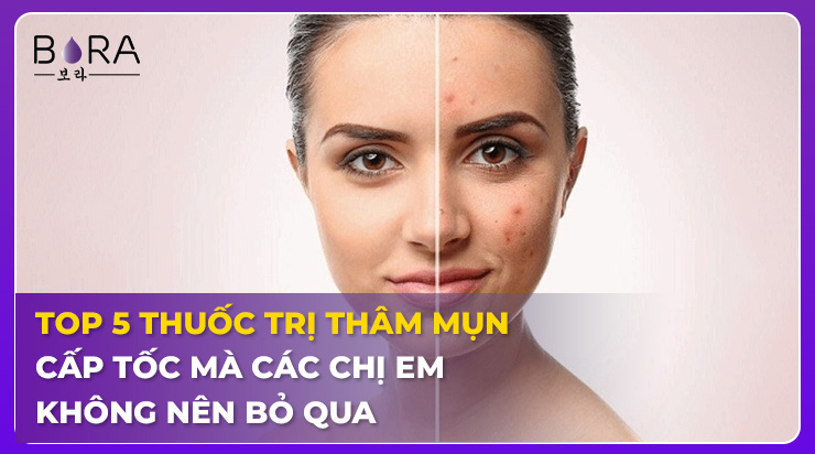 Kem trị thâm mụn cấp tốc có thể giúp làm giảm mụn tốt không?
